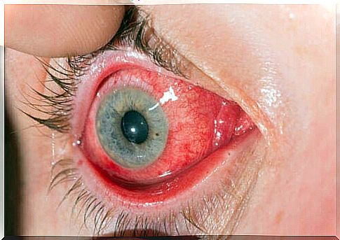 An eye with conjunctivitis.