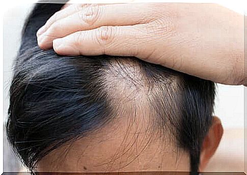 A person suffering from alopecia areata