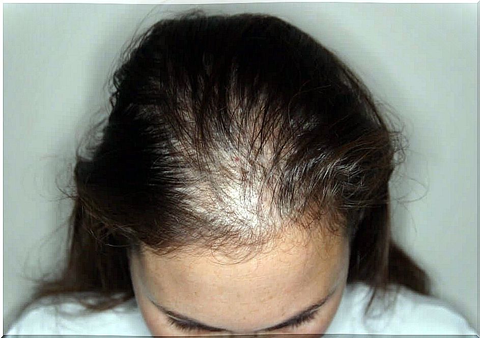 A case of alopecia areata