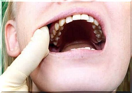 There are certain bacteria that cause cavities.