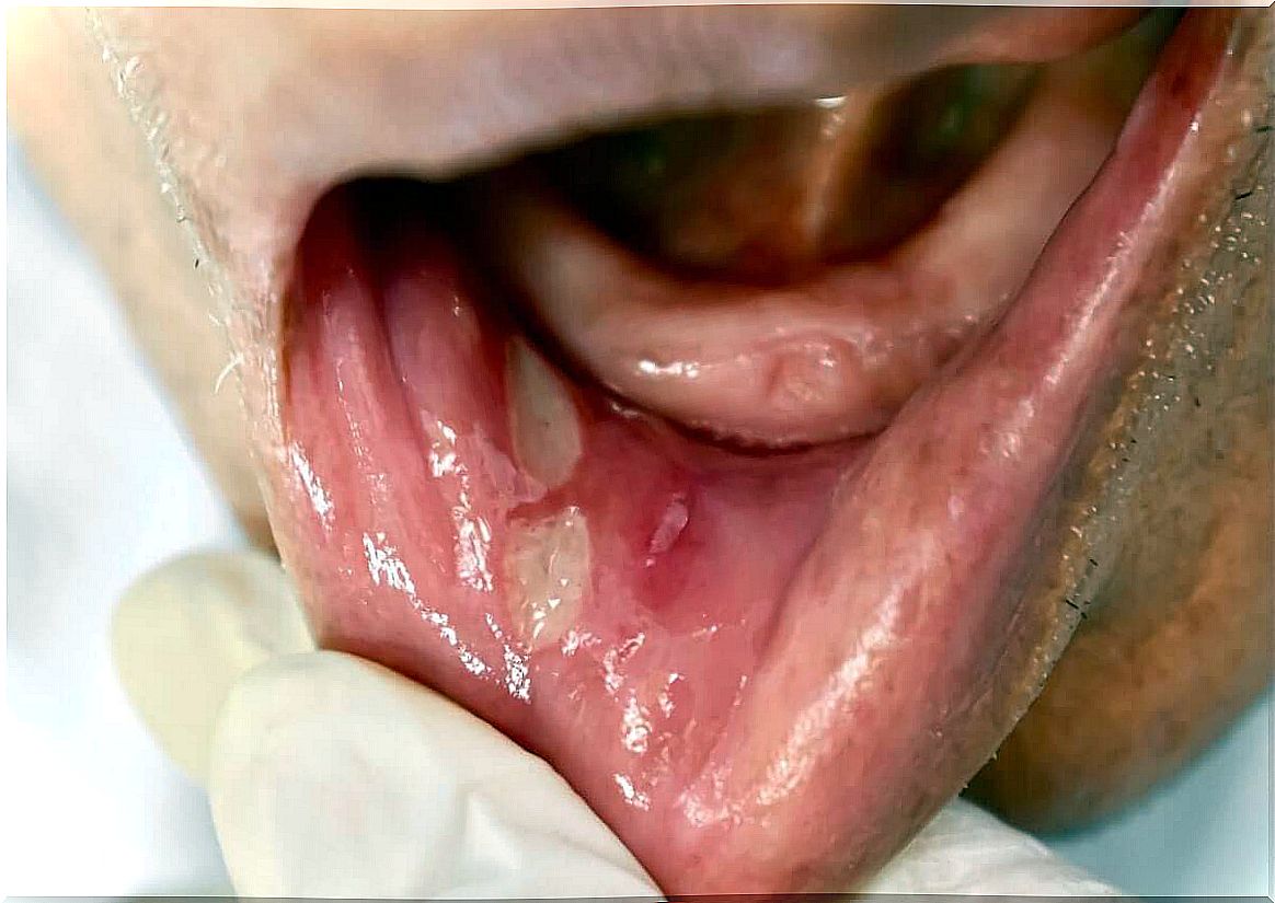 Canker sores in the mouth.