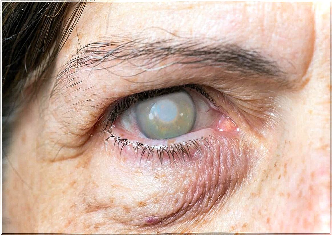 A woman with cataracts.