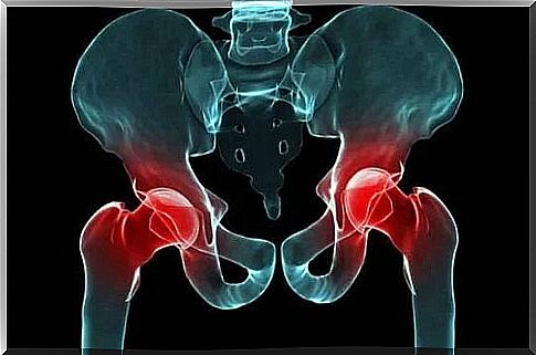 Hip dysplasia is a multi-factorial malformation.