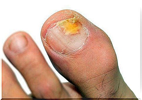 The causes of nail fungus.