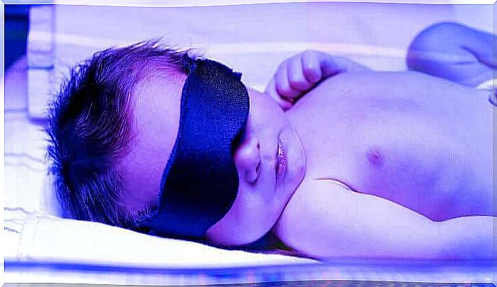 A child with jaundice during a phototherapy session