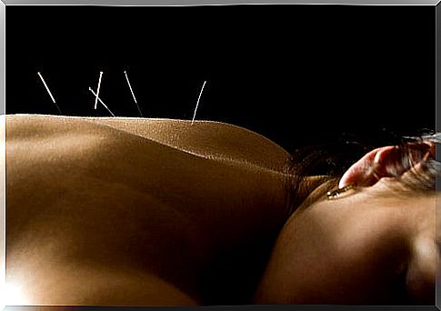 acupuncture to quit smoking