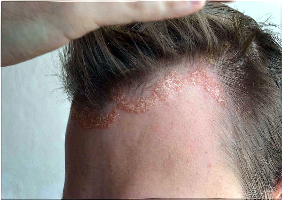 Psoriasis flare-up on the scalp. 